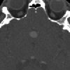 CTA Head with Aneurysm